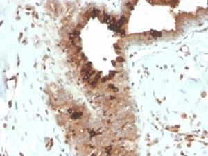 Immunohistochemical analysis of formalin-fixed, paraffin-embedded human breast carcinoma using Anti-Mammaglobin A Antibody [MGB/4057R]