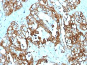 Immunohistochemical analysis of formalin-fixed, paraffin-embedded human colon carcinoma tissue using Anti-TROP2 Antibody [rTACSTD2/6395]