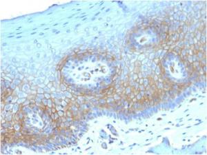 Immunohistochemical analysis of formalin-fixed, paraffin-embedded human cervical carcinoma using Anti-Thrombomodulin Antibody [THBD/1782]