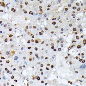 Immunohistochemistry analysis of paraffin-embedded human liver cancer using Anti-ATF2 (phospho Thr69 + Thr71) Antibody (A11004) at a dilution of 1:100 (40X lens)