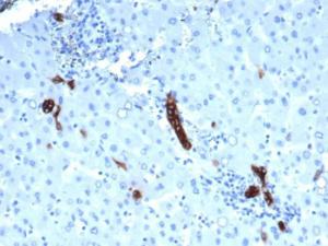 Immunohistochemical analysis of formalin-fixed, paraffin-embedded human liver carcinoma in colon tissue using Anti-TROP2 Antibody [rTACSTD2/6395]