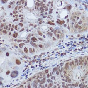 Immunohistochemistry analysis of paraffin-embedded human colon carcinoma tissue using Anti-RBMY1A1 Antibody (A308659) at a dilution of 1:100 (40x lens). Perform high pressure antigen retrieval with 10 mM citrate buffer pH 6.0 before commencing with IHC staining protocol.