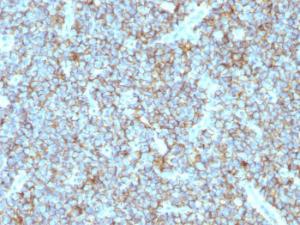 Immunohistochemical analysis of formalin-fixed, paraffin-embedded human Ewing's sarcoma using Anti-CD99 Antibody [MIC2/877]