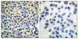 Immunohistochemical analysis of paraffin-embedded human breast carcinoma tissue using Anti-LIMK1 + LIMK2 Antibody. The right hand panel represents a negative control, where the Antibody was pre-incubated with the immunising peptide