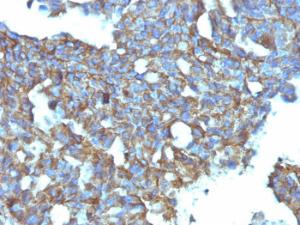 Immunohistochemical analysis of formalin-fixed, paraffin-embedded human ovarian carcinoma using Anti-CD99 Antibody [MIC2/877]