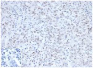 Immunohistochemical analysis of formalin-fixed, paraffin-embedded Lynch syndrome / hereditary non-polyposis colorectal cancer (HNPCC) using Anti-MLH1 Antibody [MLH1/6467] at 2µg/ml in PBS for 30 minutes at room temperature. Inset: PBS instead of the primary antibody.