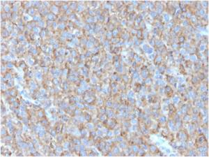 Immunohistochemical analysis of formalin-fixed, paraffin-embedded human melanoma using Anti-CD63 Antibody [LAMP3/2790]