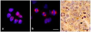 Immunocytochemistry of TPX2 using Anti-TPX2 Antibody [TPX2-01] in glioblastoma cell line T98G: interphase (a) and mitosis (b). Immunohistochemistry of TPX2 in U87MG human glioblastoma cells (orthotopic xenograft in murine brain) using Anti-TPX2 Antibody [TPX2-01] (Bar: 20µm)