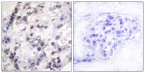 Immunohistochemical analysis of paraffin-embedded human breast carcinoma tissue using Anti-hnRNP C1 + C2 Antibody The right hand panel represents a negative control, where the antibody was pre-incubated with the immunising peptide