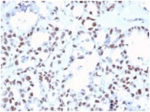 Immunohistochemical analysis of formalin-fixed, paraffin-embedded human ovarian carcinoma tissue using Anti-MLH1 Antibody [MLH1/6467]