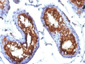 Immunohistochemical analysis of formalin-fixed, paraffin-embedded human testicular carcinoma using Anti-CD99 Antibody [MIC2/877]