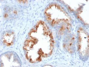 Immunohistochemical analysis of formalin-fixed, paraffin-embedded human prostate carcinoma using Anti-AMACR Antibody [AMACR/1864]