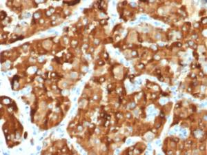 Immunohistochemical analysis of formalin-fixed, paraffin-embedded human renal cell carcinoma using Anti-AMACR Antibody [AMACR/1864]