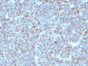 Immunohistochemical analysis of formalin-fixed, paraffin-embedded human Ewing's sarcoma using Anti-CD99 Antibody [SPM596]