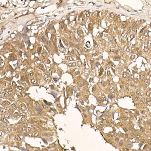 Immunohistochemistry analysis of paraffin-embedded human breast cancer tissue using Anti-AKT1 Antibody [ARC51585] (A308667) at a dilution of 1:100 (40x lens). Perform high pressure antigen retrieval with 10 mM citrate buffer pH 6.0 before commencing with IHC staining protocol.