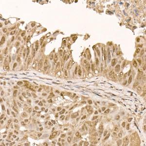 Immunohistochemistry analysis of paraffin-embedded human colon carcinoma tissue using Anti-AKT1 Antibody [ARC51585] (A308667) at a dilution of 1:100 (40x lens). Perform high pressure antigen retrieval with 10 mM citrate buffer pH 6.0 before commencing with IHC staining protocol.