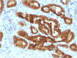 Immunohistochemical analysis of formalin-fixed, paraffin-embedded human prostate carcinoma using Anti-AMACR Antibody [AMACR/3931R]