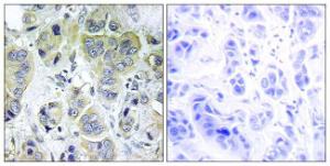 Immunohistochemical analysis of paraffin-embedded human breast carcinoma tissue using Anti-p70 S6 Kinase Antibody. The right hand panel represents a negative control, where the antibody was pre-incubated with the immunising peptide.