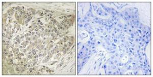 Immunohistochemical analysis of paraffin-embedded human breast carcinoma tissue using Anti-p70 S6 Kinase Antibody. The right hand panel represents a negative control, where the antibody was pre-incubated with the immunising peptide