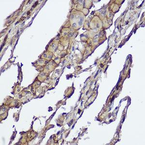 Immunohistochemistry analysis of paraffin-embedded human lung cancer using Anti-AKT1 +AKT2 Antibody [ARC2651] (A308668) at a dilution of 1:100 (40x lens) Perform high pressure antigen retrieval with 10 mM citrate buffer pH 60 before commencing with IHC staining protocol