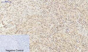 Immunohistochemical analysis of paraffin-embedded human uterus cancer tissue using Anti-p70 S6 Kinase Antibody at 1:200 (4°C overnight). Negative control was secondary antibody only