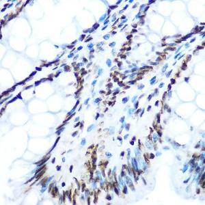 Immunohistochemistry analysis of paraffin-embedded human colon tissue using Anti-IRS1 (phospho Ser612) Antibody (A11031) at a dilution of 1:100 (40X lens). Perform microwave antigen retrieval with 10 mM Tris/EDTA buffer pH 9.0 before commencing with IHC staining protocol