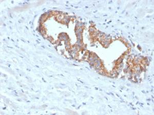 Immunohistochemical analysis of formalin-fixed, paraffin-embedded human prostate carcinoma using Anti-AMACR Antibody [AMACR/4572R]