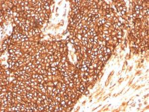 Immunohistochemical analysis of formalin-fixed, paraffin-embedded human Ewing's sarcoma using Anti-CD99 Antibody [MIC2/3478R]