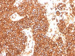 Immunohistochemical analysis of formalin-fixed, paraffin-embedded human Ewing's sarcoma using Anti-CD99 Antibody [MIC2/3478R]