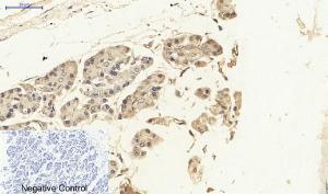 Immunohistochemical analysis of paraffin-embedded human stomach cancer tissue using Anti-NF-kappaB p65 Antibody at 1:200 (4 °C overnight). Negative control was secondary antibody only