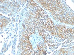 Immunohistochemical analysis of formalin-fixed, paraffin-embedded human esophageal carcinoma using Anti-TRIM29 Antibody [TRIM29/1041]