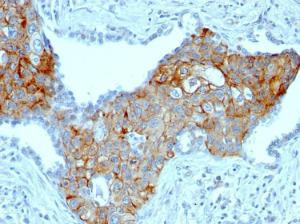 Immunohistochemical analysis of formalin-fixed, paraffin-embedded human lung squamous cell carcinoma using Anti-TRIM29 Antibody [TRIM29/1041]