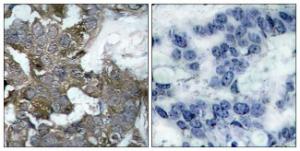 Immunohistochemical analysis of paraffin-embedded human breast carcinoma tissue using Anti-IkappaB-alpha Antibody. The right hand panel represents a negative control, where the Antibody was pre-incubated with the immunising peptide