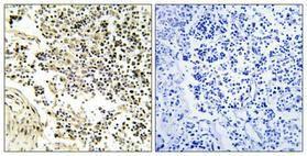 Immunohistochemical analysis of paraffin-embedded human lung cancer using Anti-IkappaB-alpha Antibody 1:100 (4°C overnight). The right hand panel represents a negative control, where the antibody was pre-incubated with the immunising peptide