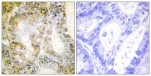 Immunohistochemical analysis of paraffin-embedded human breast carcinoma tissue using Anti-Catenin-beta1 Antibody. The right hand panel represents a negative control, where the antibody was pre-incubated with the immunising peptide