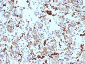 Immunohistochemical analysis of formalin-fixed, paraffin-embedded human melanoma using Anti-MiTF Antibody [MITF/915]