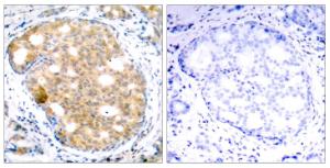 Immunohistochemical analysis of paraffin-embedded human breast carcinoma using Anti-GSK3 beta Antibody. The right hand panel represents a negative control, where the antibody was pre-incubated with the immunising peptide.