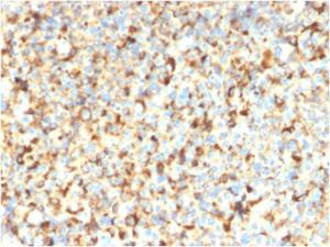 Immunohistochemical analysis of formalin-fixed, paraffin-embedded human melanoma using Anti-CD63 Antibody [rMX-49.129.5]