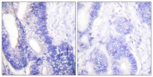 Immunohistochemical analysis of paraffin-embedded human colon carcinoma tissue using Anti-Claudin 3 Antibody. The right hand panel represents a negative control, where the antibody was pre-incubated with the immunising peptide.