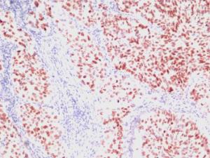 Immunohistochemical analysis of formalin-fixed, paraffin-embedded human lung carcinoma using Anti-TTF1 Antibody [SPM150]