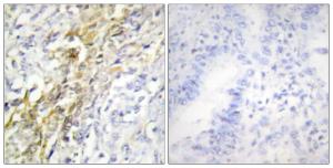 Immunohistochemical analysis of paraffin-embedded human lung carcinoma tissue using Anti-CKI-alpha Antibody. The right hand panel represents a negative control, where the Antibody was pre-incubated with the immunising peptide