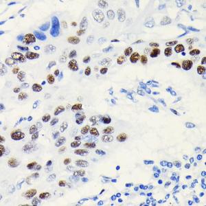 Immunohistochemistry analysis of paraffin-embedded human lung cancer using Anti-TCF-4 / TCF7L2 Antibody [ARC0027] (A307630) at a dilution of 1:100 (40x lens). Perform microwave antigen retrieval with 10 mM PBS buffer pH 7.2 before commencing with IHC staining protocol.