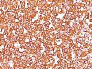 Immunohistochemical analysis of formalin-fixed, paraffin-embedded human melanoma using Anti-Vimentin Antibody [SPM576]