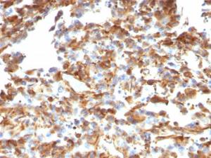 Immunohistochemical analysis of formalin-fixed, paraffin-embedded human melanoma using Anti-Vimentin Antibody [VM1170]