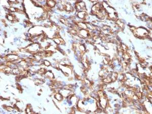 Immunohistochemical analysis of formalin-fixed, paraffin-embedded human angiosarcoma using Anti-Vimentin Antibody [VM1170]