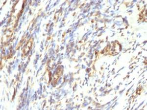 Immunohistochemical analysis of formalin-fixed, paraffin-embedded human leiomyosarcoma using Anti-Vimentin Antibody [VM1170]