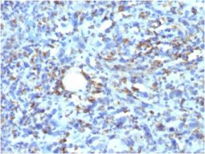 Immunohistochemical analysis of formalin-fixed, paraffin-embedded human histiocytoma using Anti-CD68 Antibody [rLAMP4/824]