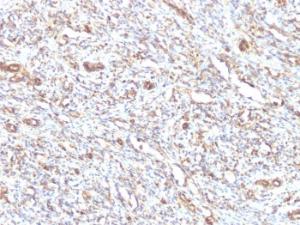 Immunohistochemical analysis of formalin-fixed, paraffin-embedded human rhabdomyosarcoma using Anti-Vimentin Antibody [VM1170]