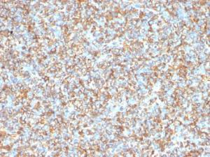 Immunohistochemical analysis of formalin-fixed, paraffin-embedded human Ewing's sarcoma using Anti-Vimentin Antibody [VM1170]