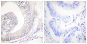 Immunohistochemical analysis of paraffin-embedded human colon carcinoma using Anti-HSL (phospho Ser855 + Ser554) Antibody. The right hand panel represents a negative control, where the antibody was pre-incubated with the immunising peptide